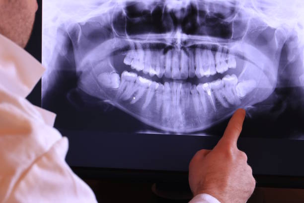 Best Knocked-Out Tooth (Avulsed Tooth) Treatment in George Mason, VA